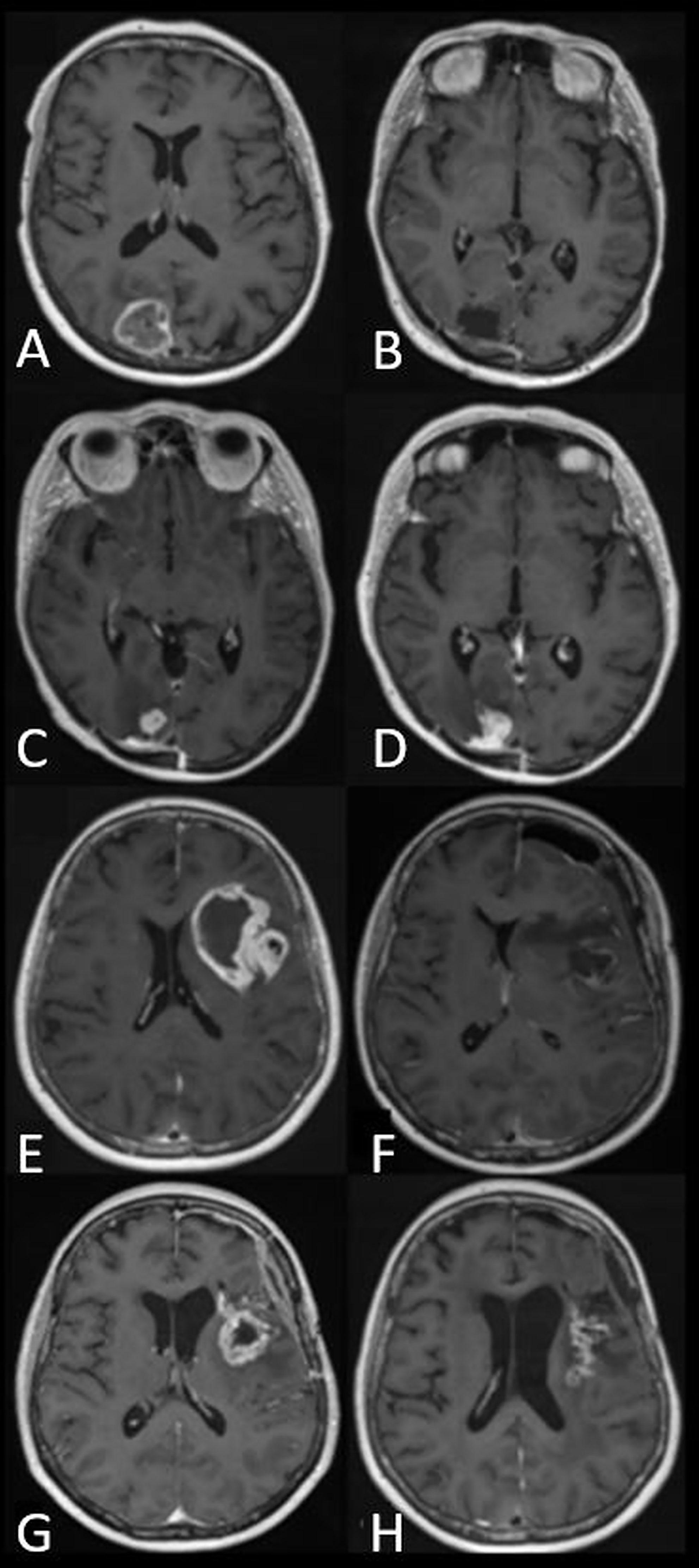 Frontiers | High-Grade Glioma Treatment Response Monitoring ...